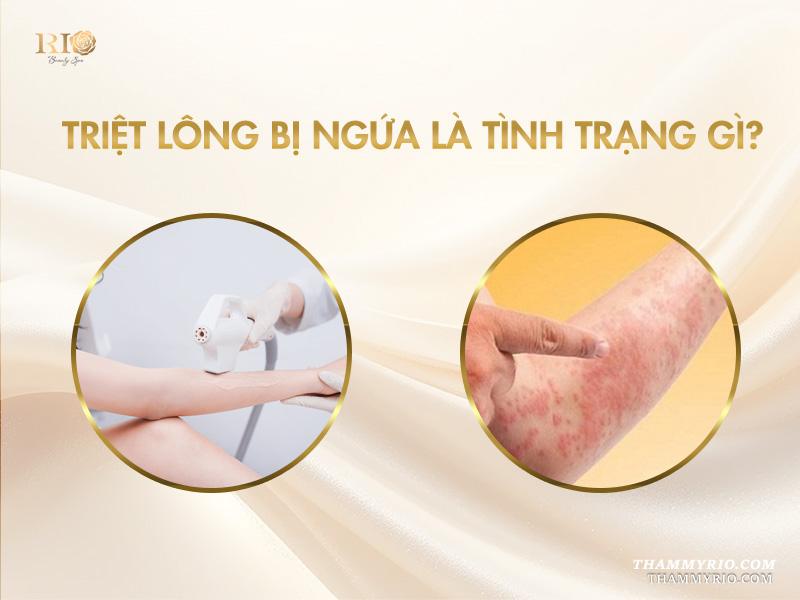 7 nguyên nhân triệt lông bị ngứa và cách khắc phục 2 Triệt lông bị ngứa là tình trạng gì?