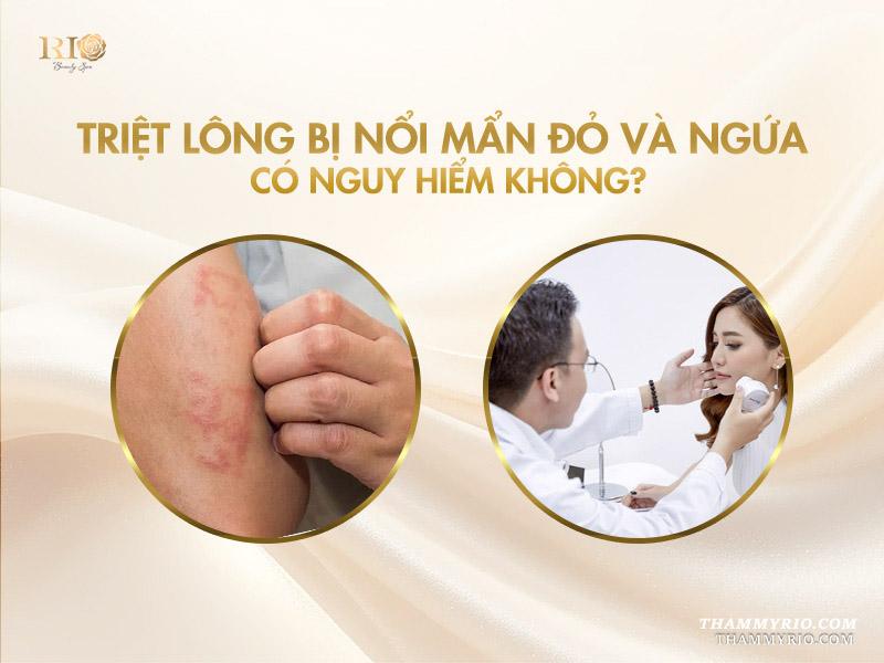 7 nguyên nhân triệt lông bị ngứa và cách khắc phục 4 Triệt lông bị nổi mẩn đỏ và ngứa có nguy hiểm không?