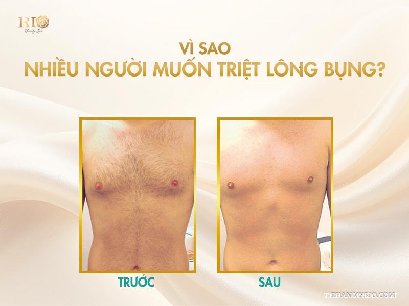Có nên triệt lông bụng không? Có các cách triệt lông bụng nào? 2 Vì sao nhiều người muốn triệt lông bụng?