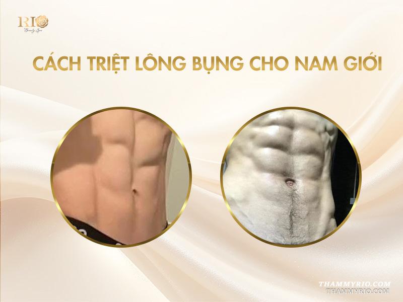 Có nên triệt lông bụng không? Có các cách triệt lông bụng nào? 4 Cách triệt lông bụng cho nam giới