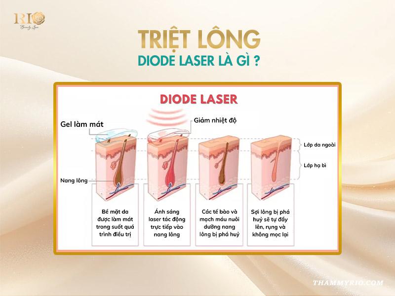 Triệt lông Diode Laser là gì? Ưu và nhược điểm 2 Triệt lông Diode Laser là gì? Ưu và nhược điểm