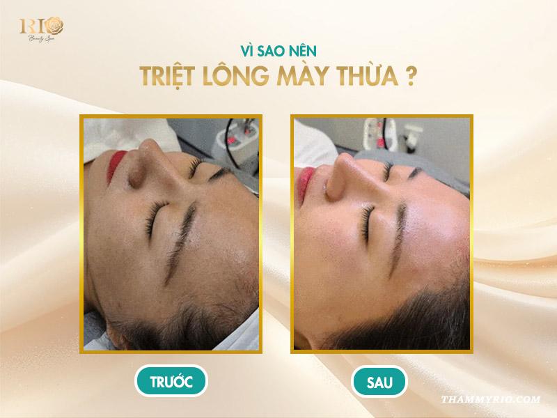 Triệt lông mày là gì? Vì sao nên triệt lông mày giao nhau? 2 Vì sao nên triệt lông mày thừa?