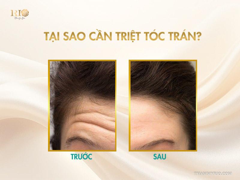 Triệt tóc trán là gì? Vì sao nên triệt chân tóc định hình trán? 2 Tại sao cần triệt tóc trán?
