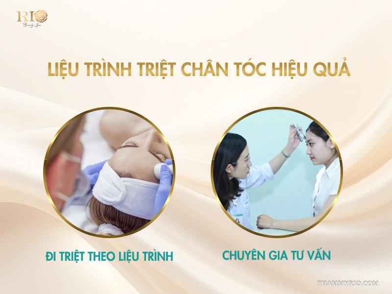 Triệt tóc trán là gì? Vì sao nên triệt chân tóc định hình trán? 6 Liệu trình triệt chân tóc hiệu quả