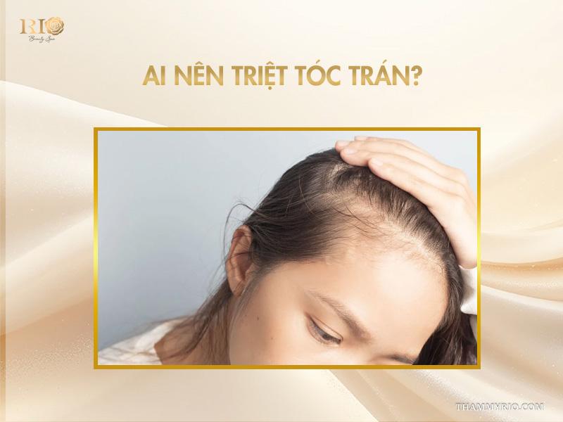 Triệt tóc trán là gì? Vì sao nên triệt chân tóc định hình trán? 4 Ai nên triệt tóc trán?