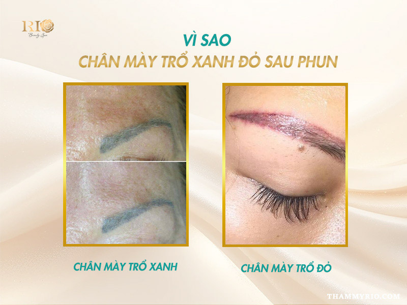 Chân mày trổ xanh, trổ đỏ sau phun: Nguyên nhân và cách xử lý 2 nguyên nhân chân mày trổ xanh đỏ sau phun xăm