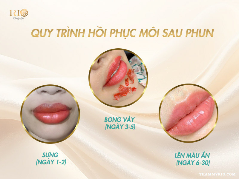 Phân biệt phun môi bị lỗi và các giai đoạn hồi phục bình thường của môi sau phun