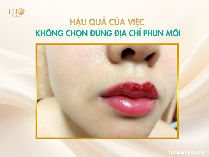 địa chỉ phun môi uy tín, hậu quả khi chọn cơ sở phun môi kém chất lượng