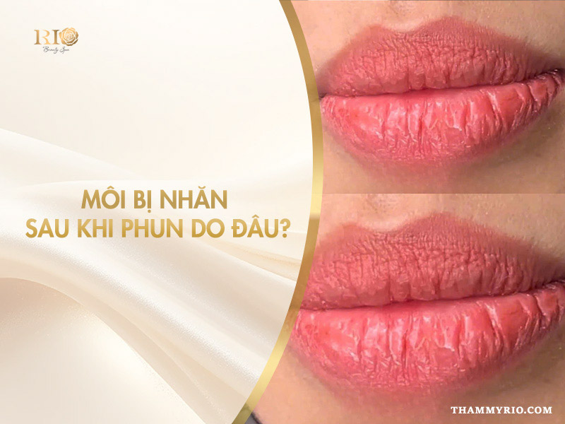 Môi Bị Nhăn Sau Khi Phun - Thẩm Mỹ Rio Beauty Clinic