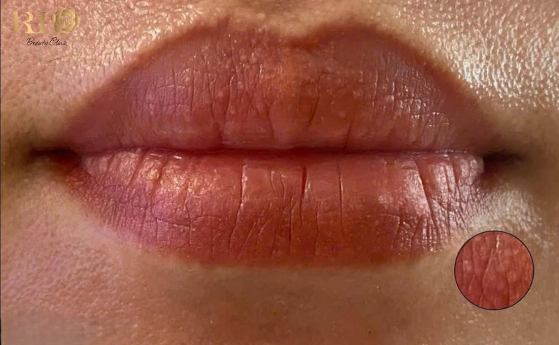 Dấu hiệu nhận biết môi bị nhăn sau khi phun.