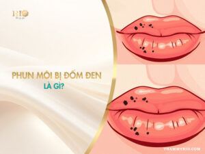 Phun môi bị đốm đen có nguy hiểm không? Dấu hiệu tăng sắc tố sau viêm