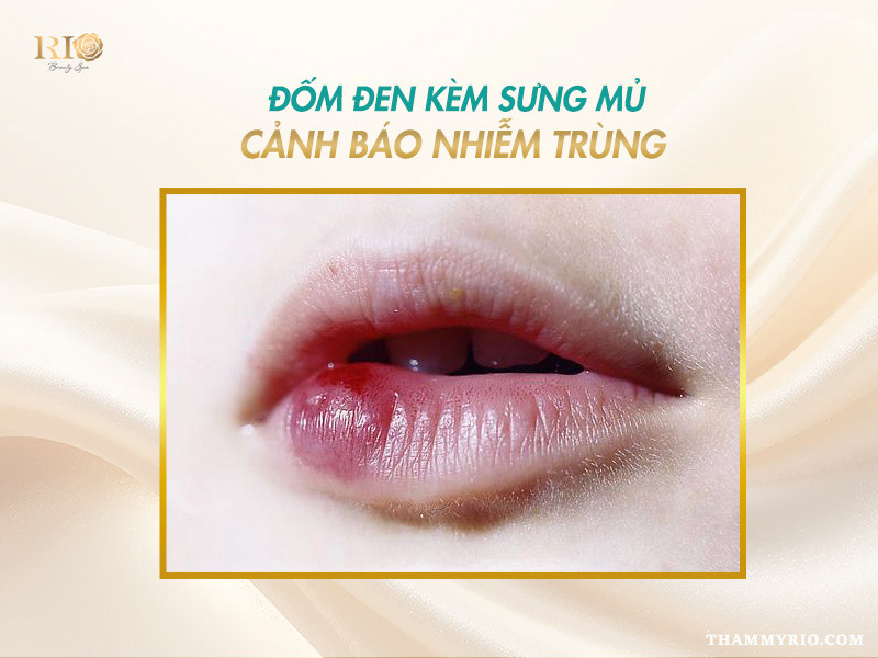 5 Nguyên Nhân Phun Môi Bị Đốm Đen và Cách Xử Lý Ngay 5 Dấu hiệu nhiễm trùng, sưng mủ khi phun môi bị đốm đen
