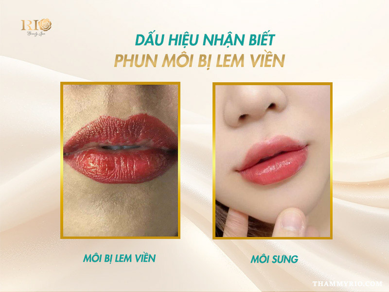 Phun môi bị lem viền: 3 Cách xử lý nhanh chóng 1 lem viền rõ rệt và môi chỉ sưng tạm thời sau phun xăm.Dấu hiệu nhận biết phun môi bị lem viền và phân biệt với sưng viền tạm thời.