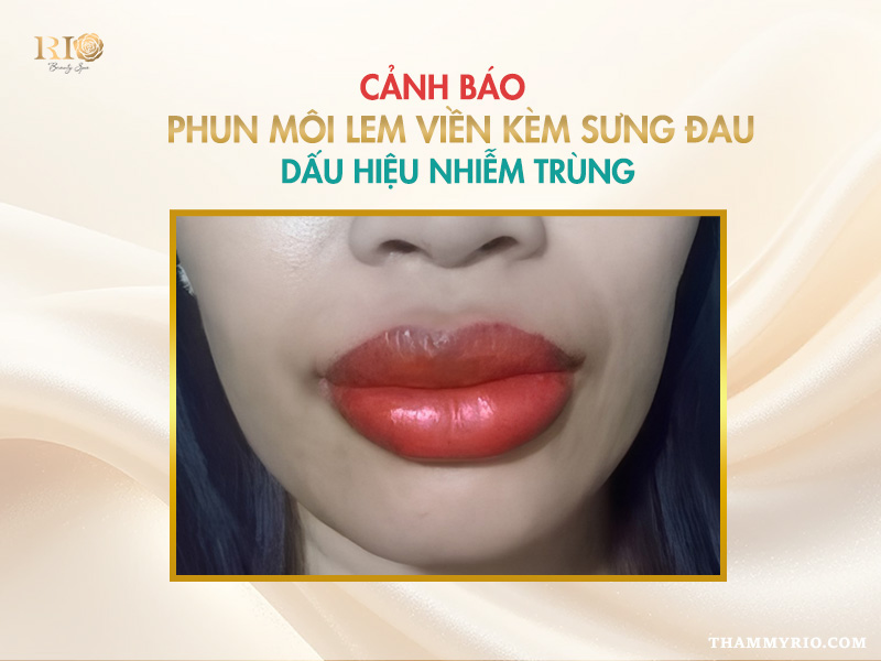 Phun môi bị lem viền: 3 Cách xử lý nhanh chóng 4 Cảnh báo phun môi bị lem viền kèm sưng đau, dấu hiệu của nhiễm trùng