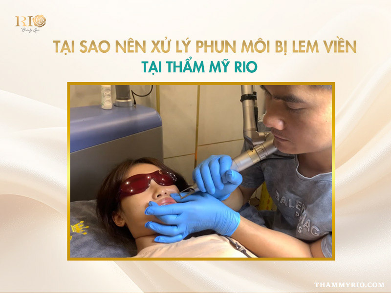 Phun môi bị lem viền: 3 Cách xử lý nhanh chóng 6 Xóa viền môi phun môi tràn viền bằng Laser Spectra Ndyag tại Thẩm Mỹ Rio