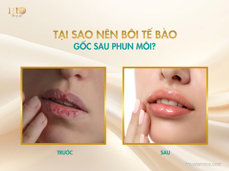 Tại sao nên bôi tế bào gốc sau phun môi?