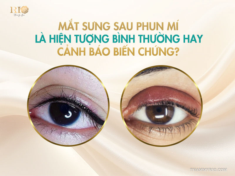 Mắt sưng sau phun mí là hiện tượng bình thường hay cảnh báo biến chứng?