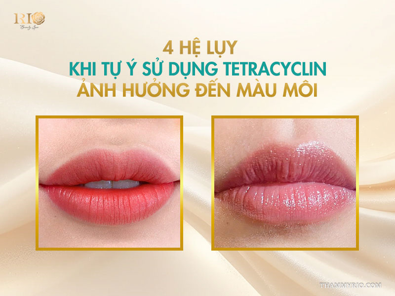 4 hệ lụy khi tự ý sử dụng Tetracyclin ảnh hưởng đến màu môi