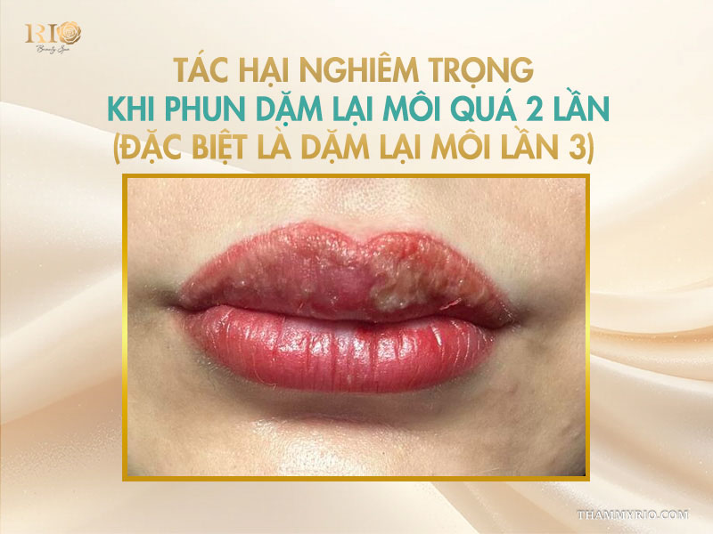 Có nên dặm lại môi lần 3 để cải thiện màu? 6 6 Tác hại nghiêm trọng khi phun dặm lại môi quá 2 lần (đặc biệt là dặm lại môi lần 3)