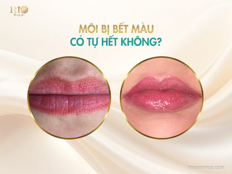 Môi bị bết màu có tự hết không – môi bị bết màu