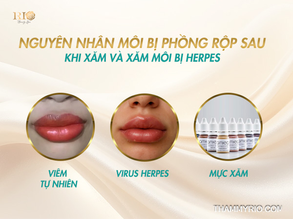 Môi sau phun bị phồng rộp: Dấu hiệu Herpes và cách trị chuẩn 1 3 nguyên nhân khiến môi sau phun bị phồng rộp, đặc biệt là virus herpes