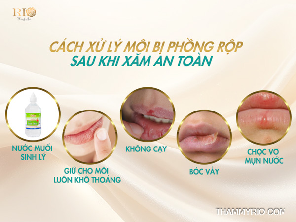 Môi sau phun bị phồng rộp: Dấu hiệu Herpes và cách trị chuẩn 3 Cách xử lý môi sau phun bị phồng rộp an toàn