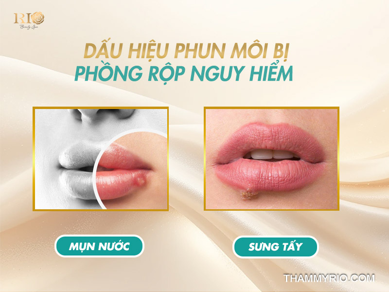 Dấu hiệu phun môi bị phồng rộp nguy hiểm