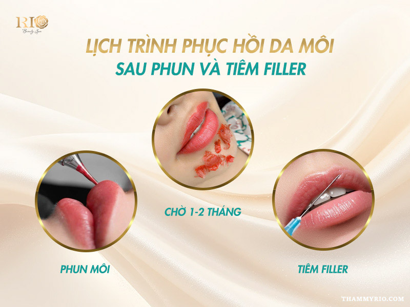 Lịch trình phục hồi da môi. Nên phun môi trước hay tiêm filler trước?