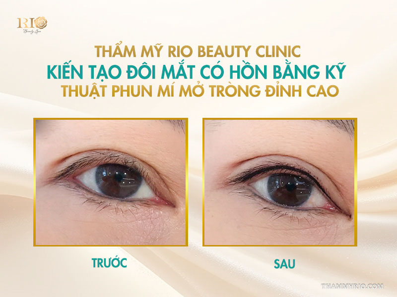 Hình thực tế từ khách hàng đã trải nghiệm phun mí mở tròng và phun mí thường tại Rio