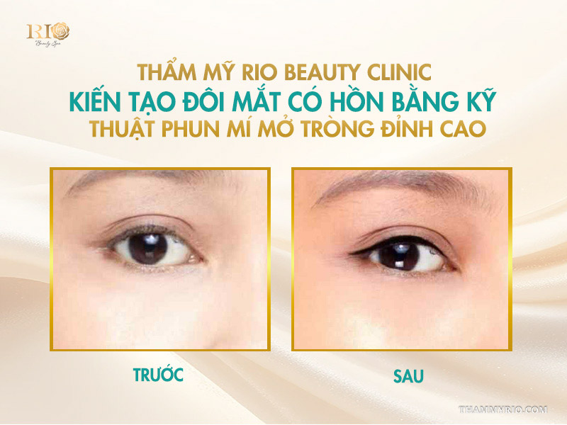 Hình thực tế từ khách hàng đã trải nghiệm phun mí mở tròng và phun mí thường tại Rio
