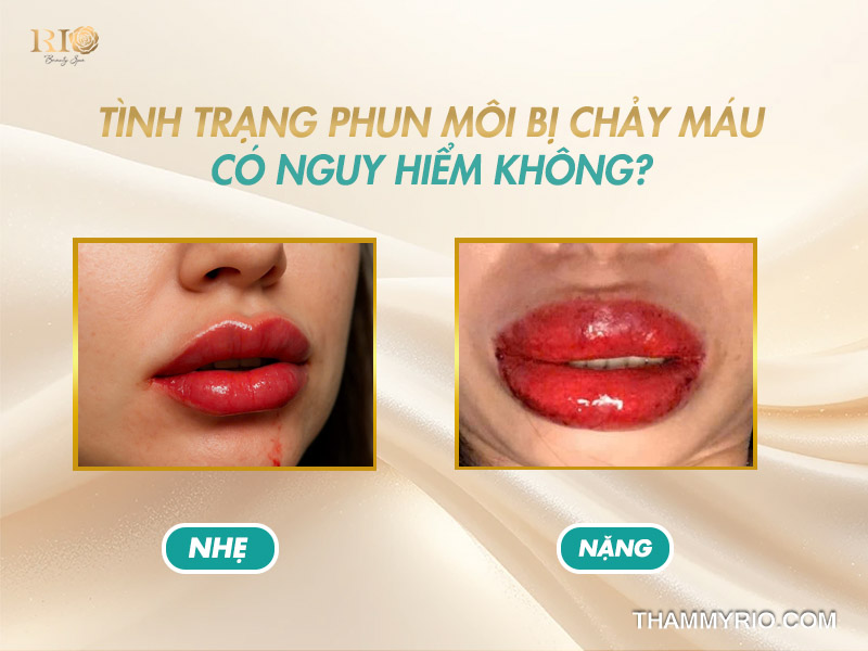 Hậu quả phun môi bị chảy máu khi không xử lý đúng cách.