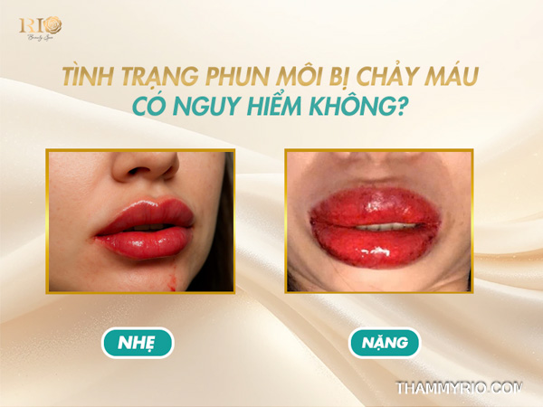 Phun môi bị chảy máu có sao không? Dấu hiệu nguy hiểm nên biết 4 Hậu quả phun môi bị chảy máu khi không xử lý đúng cách.