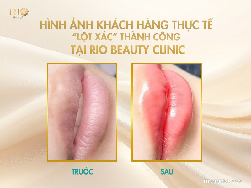 5 lợi ích tuyệt vời của công nghệ phun môi Plasma  8 Hình ảnh khách hàng thực tế phun môi Plasma thành công tại Rio Beauty Clinic