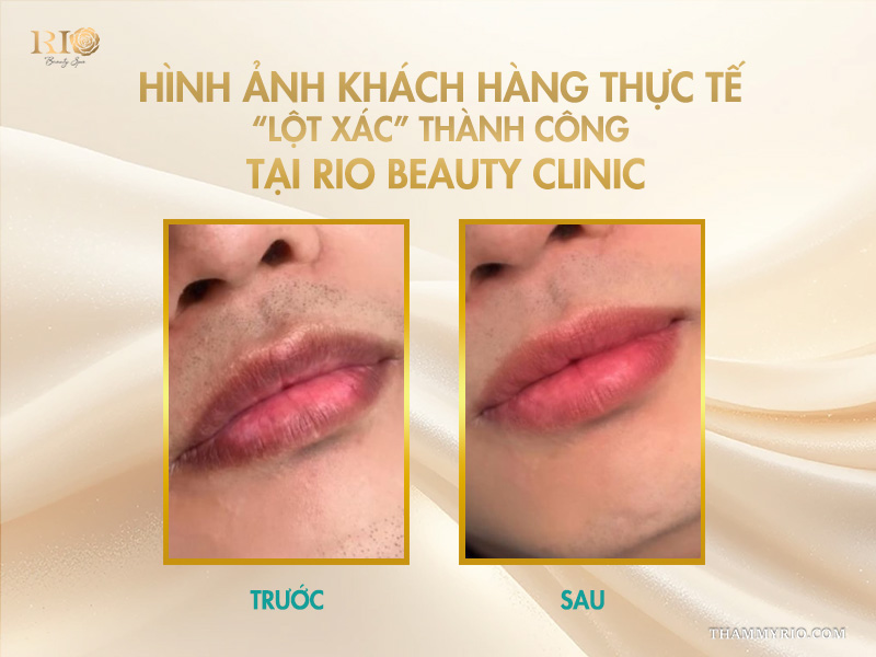 5 lợi ích tuyệt vời của công nghệ phun môi Plasma  10 Hình ảnh khách hàng thực tế phun môi Plasma thành công tại Rio Beauty Clinic