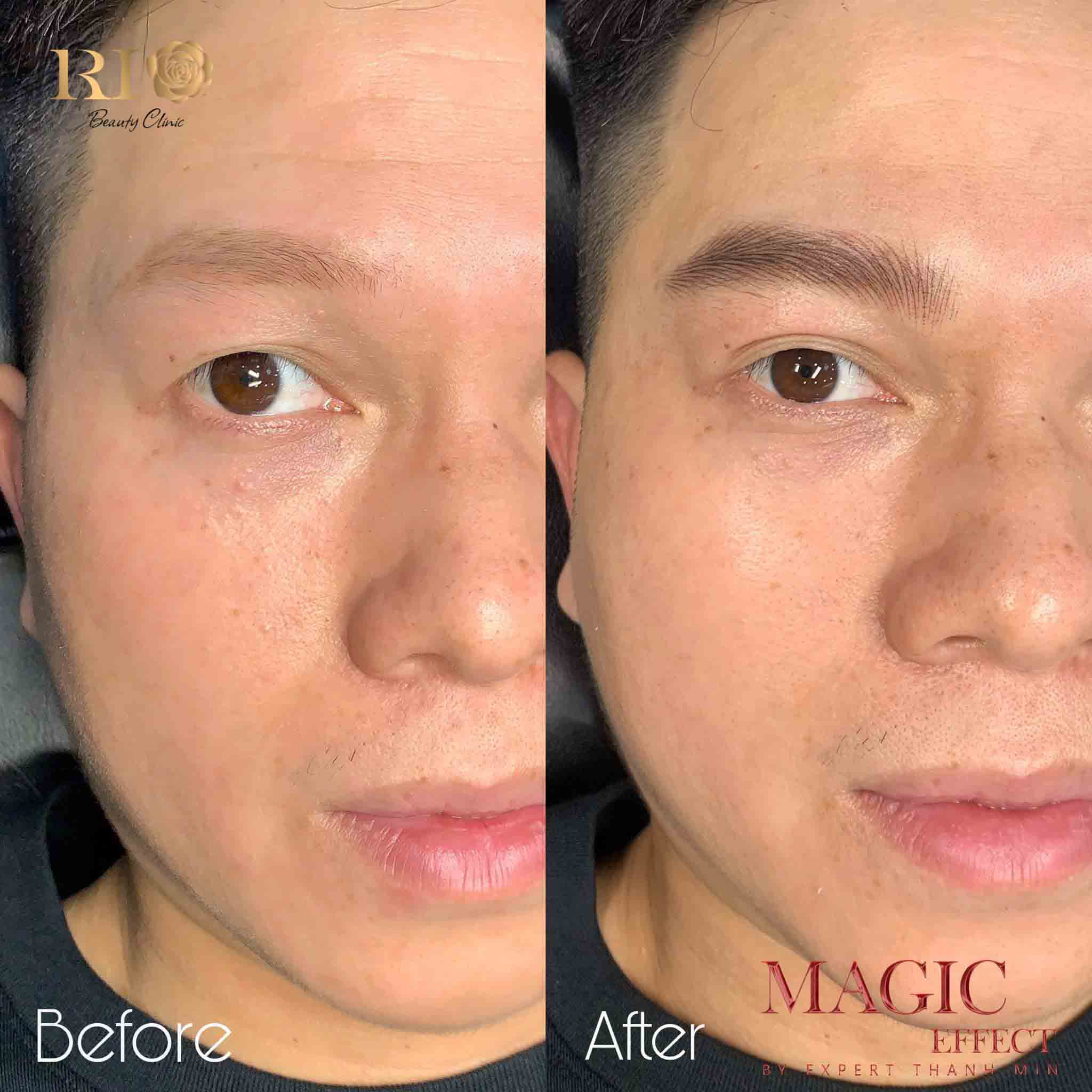 Cận cảnh kỹ thuật thêu sợi tỉ mỉ trong quy trình xăm chân mày nam tại Rio Beauty Clinic, mang lại vẻ đẹp nam tính và tự nhiên cho phái mạnh.