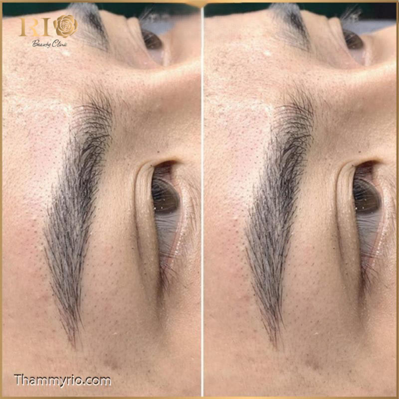Khách hàng nam rạng rỡ hạnh phúc sau khi thực hiện xăm chân mày nam tại Rio Beauty Clinic, gương mặt bừng sáng và tự tin hơn với hàng lông mày mới.