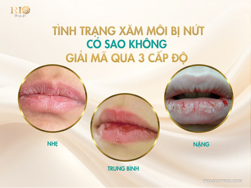 Tình trạng xăm môi bị nứt có sao không: Giải mã qua 3 cấp độ 
