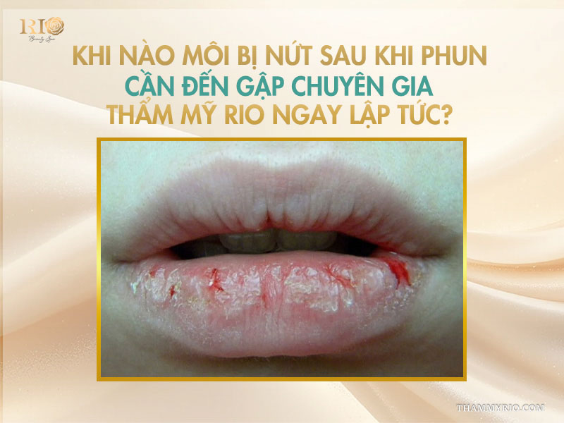 Khi nào môi bị nứt sau khi phun cần đến gặp chuyên gia Thẩm mỹ Rio ngay lập tức?