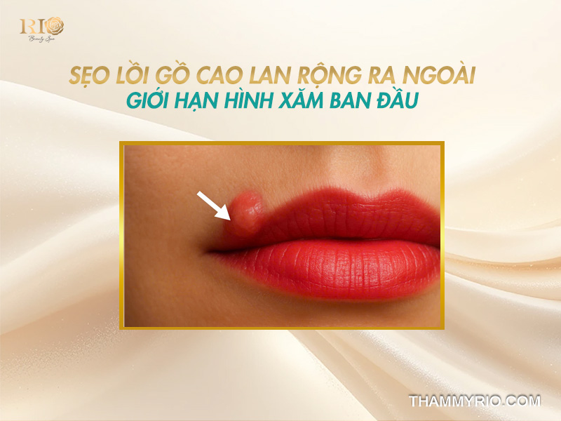 Định nghĩa và dấu hiệu nhận biết xăm môi bị sẹo lồi do tích tụ collagen dư thừa
