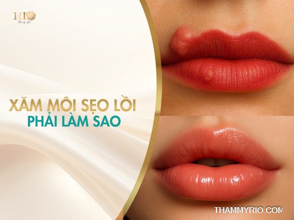 Xăm môi bị sẹo lồi phải làm sao? So sánh trước và sau khi xử lý sẹo môi