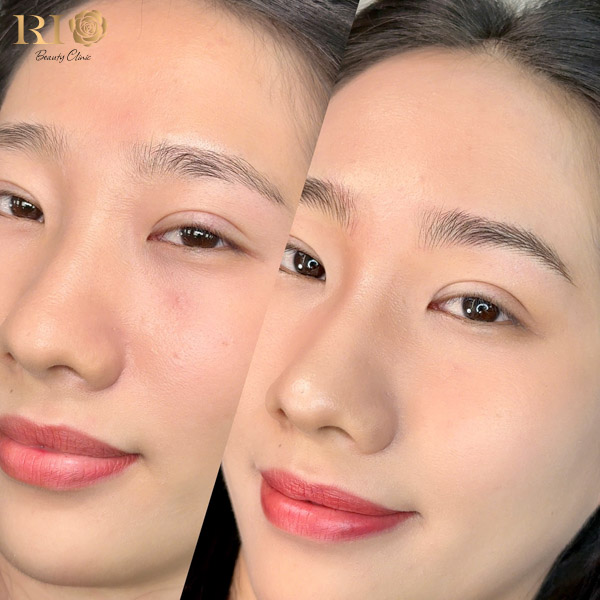 Thêu chân mày sợi đẹp bền lâu - Cập nhật giá mới nhất 2026 12 Kết quả thêu chân mày tự nhiên tại Thẩm Mỹ Rio