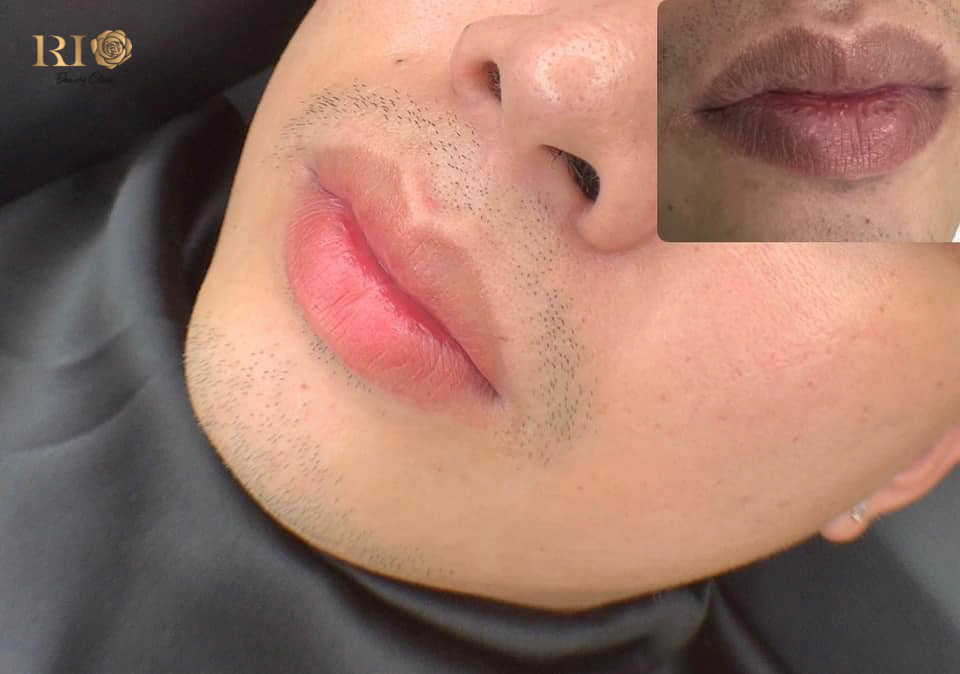 Artist Master Mely Thao: The Global PMU Educator and Master Artisan 5 Before and After photo of Male Dark Lip Neutralization procedure by expert at Rio Beauty Clinic