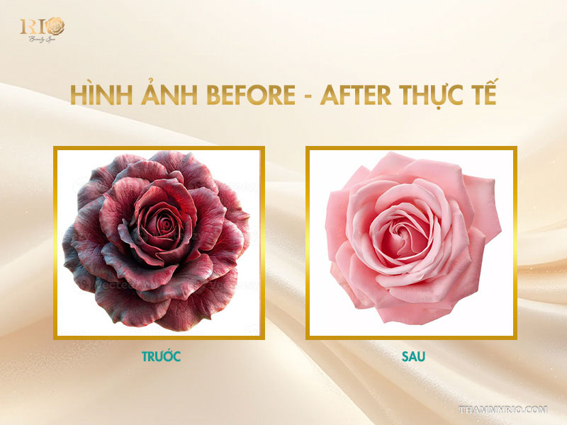 Hiệu quả sau khi làm hồng nhũ hoa tại Rio