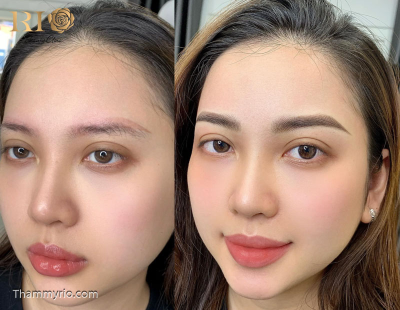 dieu khac long may hairstroke tham my rio beauty clinic 81 of 148