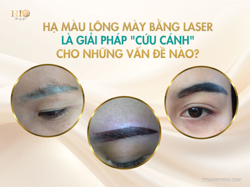 Hạ màu lông mày bằng laser là giải pháp "cứu cánh" cho những vấn đề nào? 