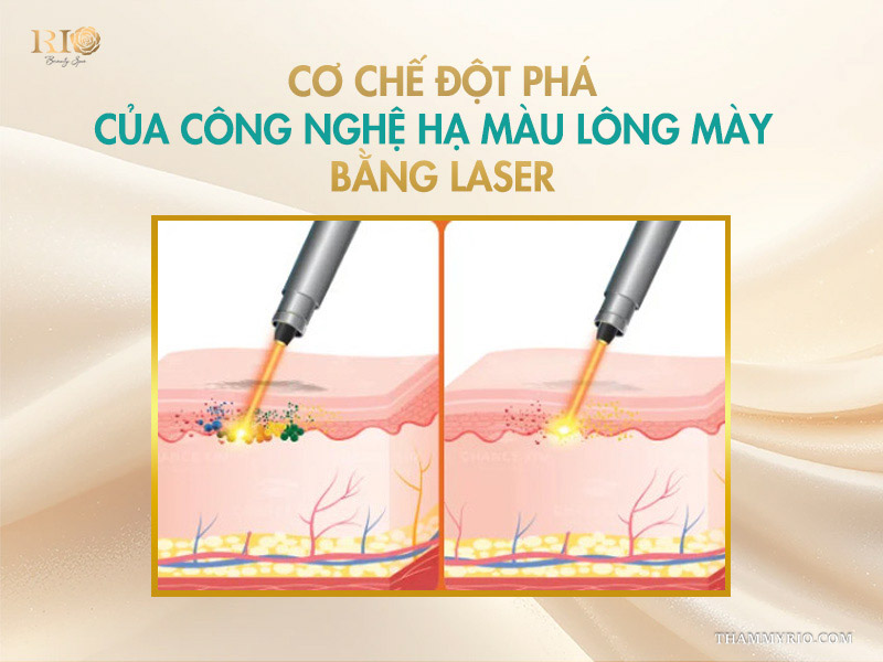 Cơ chế đột phá của công nghệ hạ màu lông mày bằng laser 
