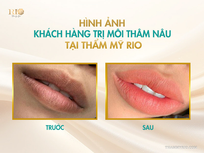 Cách khắc phục môi thâm nâu hiệu quả nhất 2026 11 Môi thâm xỉn lâu năm do dùng son chì