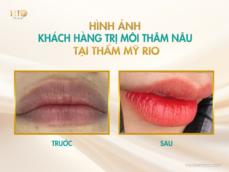Cách khắc phục môi thâm nâu hiệu quả nhất 2026 10 Ảnh before - after môi thâm viền đậm và thâm xỉn toàn bộ + sau khi khử thâm kết hợp phun màu Đỏ Cam San Hô
