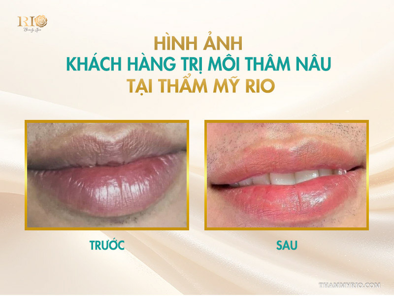 Cách khắc phục môi thâm nâu hiệu quả nhất 2026 9 Môi thâm nâu sẫm, viền môi đậm, thiếu sức sống.