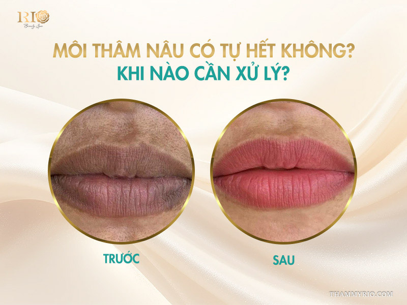 Cách khắc phục môi thâm nâu hiệu quả nhất 2026 5 Môi thâm nâu có tự hết không? Khi nào cần xử lý?